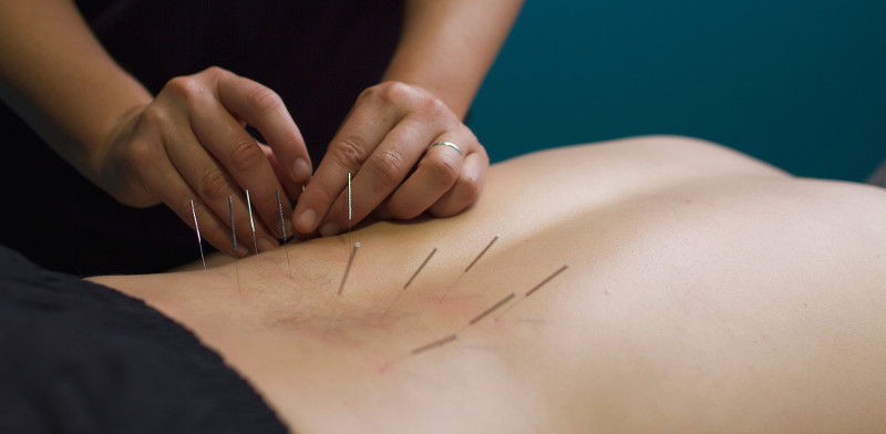 What is Functional Dry Needling in Physical Therapy